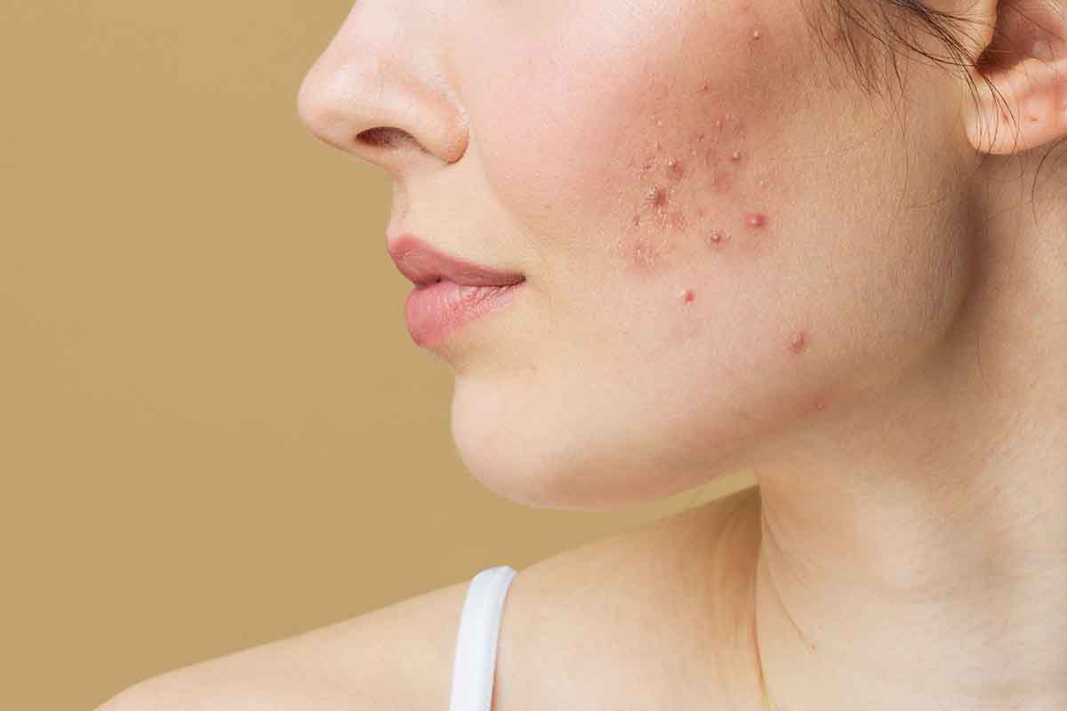 Common Causes Triggers and Types of Acne